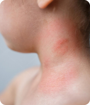 Child's neck showing signs of irritation or rash, relevant to discussions on Lyme disease treatment and overall health restoration at Apex Chiropractic & Wellness Center.